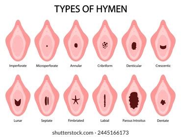 hymen pic|Hymen Types, Illustration